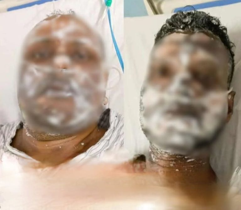 दो कर्मी झुलसे