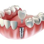 IMPLANT