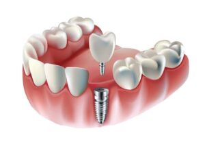 IMPLANT